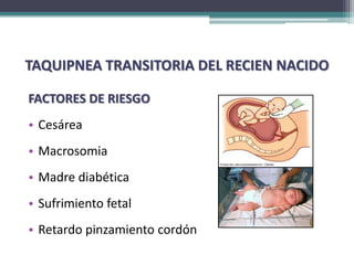 TAQUIPNEA TRANSITORIA DEL RECIEN NACIDO

FACTORES DE RIESGO
• Cesárea
• Macrosomia
• Madre diabética
• Sufrimiento fetal
• Retardo pinzamiento cordón
 
