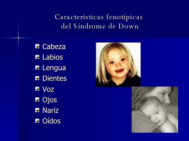 Sindrome De Down