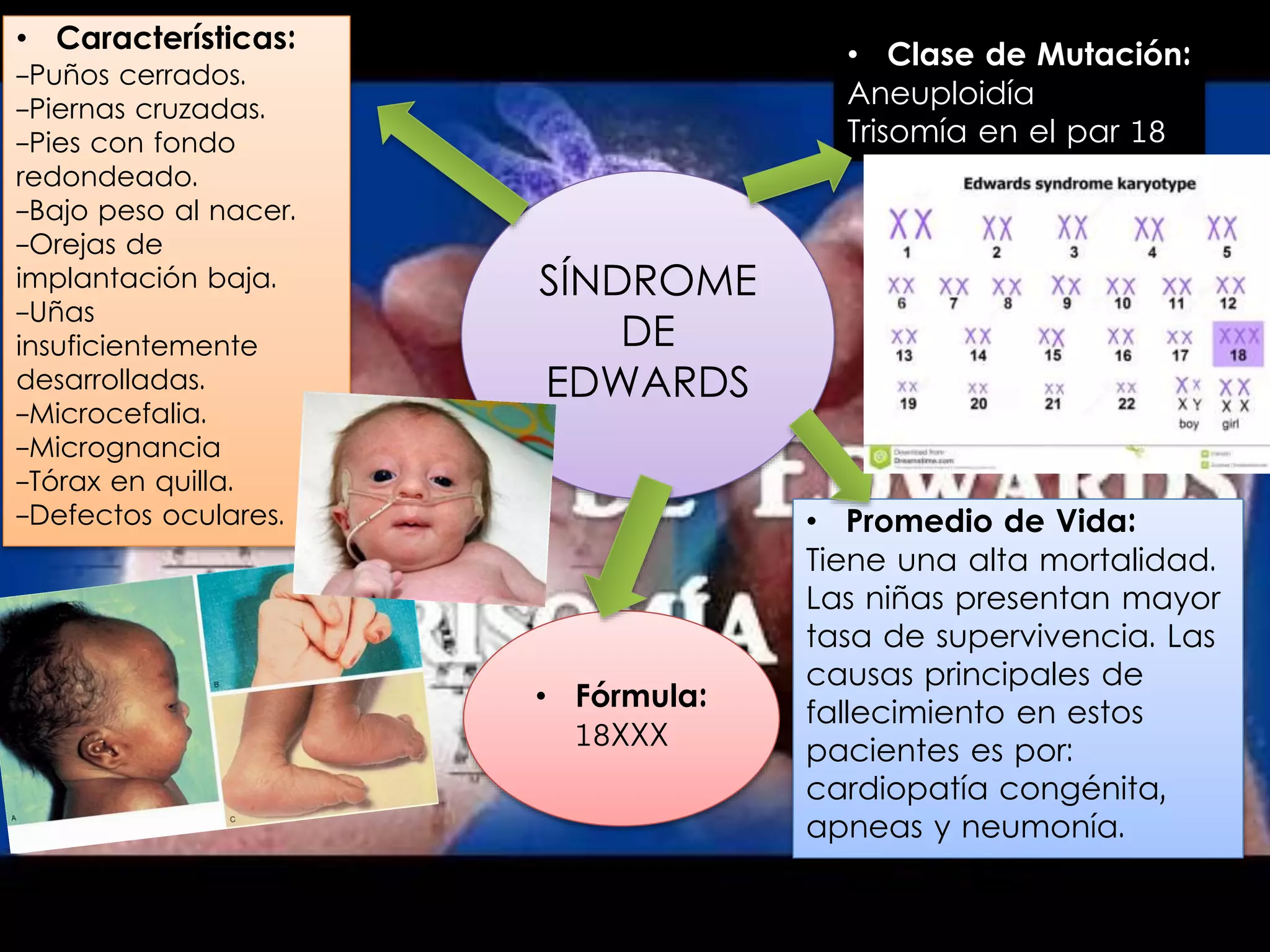 Sindrome de-edwards | PPTX