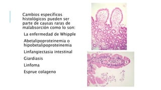 Cambios específicos
histológicos pueden ser
parte de causas raras de
malabsorción como lo son:
La enfermedad de Whipple
Abetalipoproteinemia o
hipobetalipoproteinemia
Linfangiectasia intestinal
Giardiasis
Linfoma
Esprue colageno
 