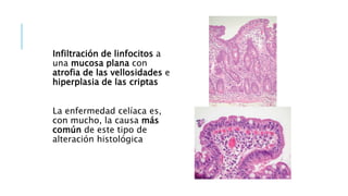 Infiltración de linfocitos a
una mucosa plana con
atrofia de las vellosidades e
hiperplasia de las criptas
La enfermedad celíaca es,
con mucho, la causa más
común de este tipo de
alteración histológica
 