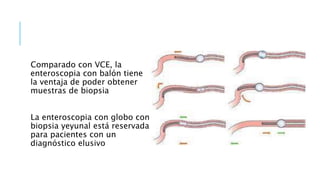 Comparado con VCE, la
enteroscopia con balón tiene
la ventaja de poder obtener
muestras de biopsia
La enteroscopia con globo con
biopsia yeyunal está reservada
para pacientes con un
diagnóstico elusivo
 