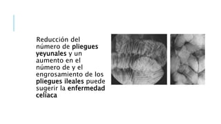 Reducción del
número de pliegues
yeyunales y un
aumento en el
número de y el
engrosamiento de los
pliegues ileales puede
sugerir la enfermedad
celíaca
 