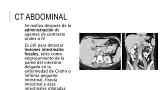 CT ABDOMINAL
Se realiza después de la
administración de
agentes de contraste
orales o IV
Es útil para detectar
lesiones intestinales
focales, tales como
engrosamiento de la
pared del intestino
delgado en la
enfermedad de Crohn o
linfoma pequeño
intestinal, fístula
intestinal y asas
intestinales dilatadas
 