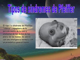 Tipos de sindromes de Pfeiffer El tipo 1 o síndrome de Pfeiffer “clásico'', hipoplasia de la porción media de la cara y anomalías de los dedos de los pies y de las manos. Se asocia con una inteligencia normal y con un pronóstico general bueno.  