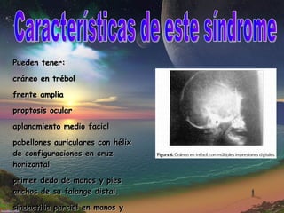 Características de este síndrome Pueden tener: cráneo en trébol frente amplia  proptosis ocular aplanamiento medio facial pabellones auriculares con hélix de configuraciones en cruz horizontal  primer dedo de manos y pies anchos de su falange distal. sindactilia parcial en manos y pies 