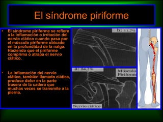 • El síndrome piriforme se refiere
a la inflamación o irritación del
nervio ciático cuando pasa por
el músculo piriforme ubicado
en la profundidad de la nalga.
Haciendo que el piriforme
comprima o atrapa el nervio
ciático.
• La inflamación del nervio
ciático, también llamado ciática,
produce dolor en la parte
trasera de la cadera que
muchas veces se transmite a la
pierna.
El síndrome piriforme
 