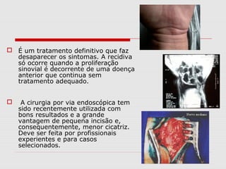  É um tratamento definitivo que faz
desaparecer os sintomas. A recidiva
só ocorre quando a proliferação
sinovial é decorrente de uma doença
anterior que continua sem
tratamento adequado.
 A cirurgia por via endoscópica tem
sido recentemente utilizada com
bons resultados e a grande
vantagem de pequena incisão e,
consequentemente, menor cicatriz.
Deve ser feita por profissionais
experientes e para casos
selecionados.
 