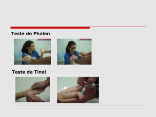 Teste de Phalen
Teste de Tinel
 