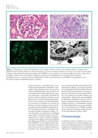 N EFROLO GÍA
Síndrome nefrítico
O. Mur y G. de la Mata

A

B

C

D

Humps

Figura 1. a) Glomérulo normal al microscopio óptico. La luz capilar está libre y el espesor de la membrana capilar es similar al de la
membrana basal del epitelio tubular. Las células mesangiales y la matriz mesangial se localizan en el centro o en la “cola” del ovillo capilar.
b) Imagen de glomerulonefritis aguda postestreptocócica (GNAPE), en la que puede verse la acusada proliferación celular e infiltración de
neutrófilos, y obliteración de la luz capilar. c) Depósitos granulares de inmunoglobulina G en la pared capilar. Imagen por
inmunofluorescencia con anticuerpos antiinmunoglobulina G. d) Microscopia electrónica en la GNAPE, en la que pueden verse los
característicos depósitos subepiteliales (humps o “jorobas”).

cleares, monocitos y eosinófilos (fig. 1). Los
términos glomerulonefritis endocapilar e intracapilar son apropiados para este caso, ya que la
reacción inflamatoria tiene lugar por dentro de
la membrana basal capilar, que limita los espacios endocapilar y extracapilar (epitelial). El
grado de oclusión capilar se correlaciona con el
descenso de la tasa de filtración glomerular9.
En los casos más graves las células epiteliales y
los monocitos se acumulan en el espacio de
Bowman y forman semilunas, lo que ocasiona
una glomerulonefritis rápidamente progresiva.
Por inmunofluorescencia se manifiesta como
un patrón granular de depósitos de IgG y C3
en el glomérulo, cuya disposición y morfología
varían según el momento evolutivo de la enfermedad en que se realice el estudio histológico,
circunstancia que algunos autores han utilizado
para elaborar una clasificación clinicopatológica
de la GNAPE10. La inmunofluorescencia permite realizar el diagnóstico diferencial con otros
procesos que cursan con síndrome nefrítico, en
particular con la nefropatía IgA, pues en ésta
218

An Pediatr Contin 2004;2(4):216-22

(ya se trate de la afectación renal exclusiva de la
enfermedad de Berger, o de la forma sistémica
de la enfermedad de Schönlein-Henoch) el depósito de IgA es predominante. La imagen típica que se describe en la microscopia electrónica es la presencia de “jorobas” (humps), que
corresponden a depósitos de inmunocomplejos
de localización subepitelial y que son más evidentes en las primeras semanas del proceso, con
tendencia posterior a ir disminuyendo. Aunque
las lesiones glomerulares son las que predominan en la histología de la GNAPE, también
puede observarse afectación tubulointersticial,
en forma de infiltración celular y edema.

Fisiopatología
La afectación renal se manifiesta como consecuencia del depósito de inmunocomplejos en el
interior del capilar glomerular, la activación del
complemento y la liberación de los mediadores
inflamatorios11. Paralelamente al depósito glo30

 