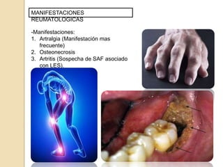 MANIFESTACIONES
REUMATOLOGICAS
-Manifestaciones:
1. Artralgia (Manifestación mas
frecuente)
2. Osteonecrosis
3. Artritis (Sospecha de SAF asociado
con LES).
 