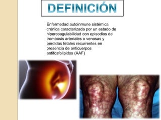 Enfermedad autoinmune sistémica
crónica caracterizada por un estado de
hipercoagulabilidad con episodios de
trombosis arteriales o venosas y
perdidas fetales recurrentes en
presencia de anticuerpos
antifosfolipidos (AAF)
 