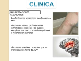 MANIFESTACIONES
VASCULARES
Los fenómenos tromboticos mas frecuentes
son:
-Trombosis venosa profunda en las
extremidades inferiores : se pueden
complicar con trombo embolismo pulmonar
o hipertensión pulmonar
-Trombosis arteriales cerebrales que se
manifiestan en forma de ACV
 