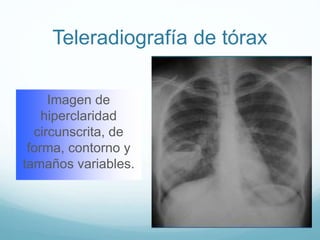 Teleradiografía de tórax 
Imagen de 
hiperclaridad 
circunscrita, de 
forma, contorno y 
tamaños variables. 
 
