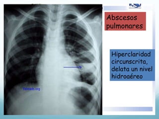 Abscesos 
pulmonares 
Hiperclaridad 
circunscrita, 
delata un nivel 
hidroaéreo 
 