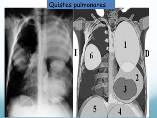 Quistes pulmonares 
