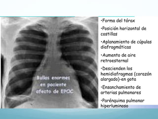 Sx. de rarefacción difuso o 
enfisema pulmonar 
• Forma del tórax 
• Posición horizontal de 
costillas 
• Aplanamiento de cúpulas 
diafragmáticas 
• Aumento de aire 
retroesternal 
• Descienden los 
hemidiafragmas (corazón 
alargado)-en gota 
• Ensanchamiento de 
arterias pulmonares 
• Parénquima pulmonar 
hiperluminoso 
rarefacción difuso 
pulmonar 
movilidad torácica 
 
