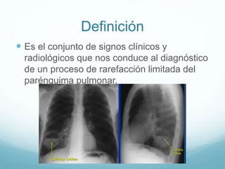 Definición 
 Es el conjunto de signos clínicos y 
radiológicos que nos conduce al diagnóstico 
de un proceso de rarefacción limitada del 
parénquima pulmonar. 
 