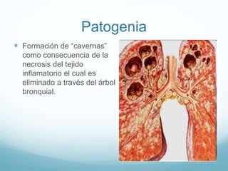 Patogenia 
 Formación de “cavernas” 
como consecuencia de la 
necrosis del tejido 
inflamatorio el cual es 
eliminado a través del árbol 
bronquial. 
 