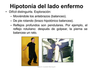 Hipotonía Se caracteriza por una resistencia disminuida a la palpación o manipulación pasiva de los músculos; por lo general, se acompaña de reflejos osteotendinosos disminuidos y de tipo pendular, junto a un llamativo fenómeno de rebote en la prueba de Stewart-Holmes.