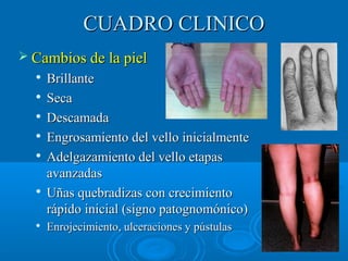 CCUUAADDRROO CCLLIINNIICCOO 
 CCaammbbiiooss ddee llaa ppiieell 
 BBrriillllaannttee 
 SSeeccaa 
 DDeessccaammaaddaa 
 EEnnggrroossaammiieennttoo ddeell vveelllloo iinniicciiaallmmeennttee 
 AAddeellggaazzaammiieennttoo ddeell vveelllloo eettaappaass 
aavvaannzzaaddaass 
 UUññaass qquueebbrraaddiizzaass ccoonn ccrreecciimmiieennttoo 
rrááppiiddoo iinniicciiaall ((ssiiggnnoo ppaattooggnnoommóónniiccoo)) 
 EEnnrroojjeecciimmiieennttoo,, uullcceerraacciioonneess yy ppúússttuullaass 
 