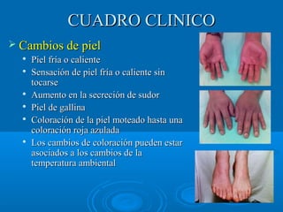 CCUUAADDRROO CCLLIINNIICCOO 
 CCaammbbiiooss ddee ppiieell 
 PPiieell ffrrííaa oo ccaalliieennttee 
 SSeennssaacciióónn ddee ppiieell ffrrííaa oo ccaalliieennttee ssiinn 
ttooccaarrssee 
 AAuummeennttoo eenn llaa sseeccrreecciióónn ddee ssuuddoorr 
 PPiieell ddee ggaalllliinnaa 
 CCoolloorraacciióónn ddee llaa ppiieell mmootteeaaddoo hhaassttaa uunnaa 
ccoolloorraacciióónn rroojjaa aazzuullaaddaa 
 LLooss ccaammbbiiooss ddee ccoolloorraacciióónn ppuueeddeenn eessttaarr 
aassoocciiaaddooss aa llooss ccaammbbiiooss ddee llaa 
tteemmppeerraattuurraa aammbbiieennttaall 
 