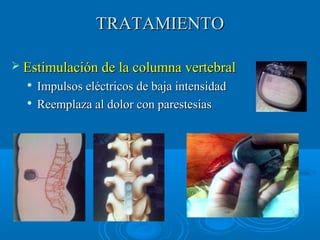 TTRRAATTAAMMIIEENNTTOO 
 EEssttiimmuullaacciióónn ddee llaa ccoolluummnnaa vveerrtteebbrraall 
 IImmppuullssooss eellééccttrriiccooss ddee bbaajjaa iinntteennssiiddaadd 
 RReeeemmppllaazzaa aall ddoolloorr ccoonn ppaarreesstteessiiaass 
 