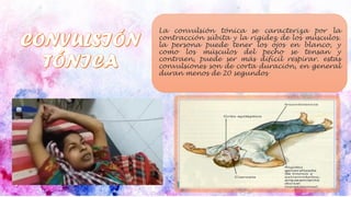 La convulsión tónica se caracteriza por la
contracción súbita y la rigidez de los músculos.
la persona puede tener los ojos en blanco, y
como los músculos del pecho se tensan y
contraen, puede ser más difícil respirar. estas
convulsiones son de corta duración, en general
duran menos de 20 segundos
 