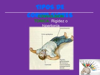 TIPOS DE
CONVULSIONES
   CONVULSION
 TONICA: Rigidez o
    hipertonía
 