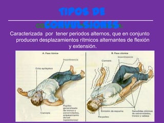TIPOS DE
            CONVULSIONES
          CONVULSION TONICO CLONICA:
Caracterizada por tener periodos alternos, que en conjunto
  producen desplazamientos rítmicos alternantes de flexión
                        y extensión.
 