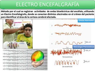 ELECTRO ENCEFALGRAFÍA
Método por el cual se registran actividades de ondas bioeléctricas del encéfalo, utilizando
un Electro Encefalografo, donde se conectan distintos electrodos en el cráneo del paciente
para identificar el área de la corteza cerebral afectada.
Ondas Normales
Descargas Paroxísticas
 
