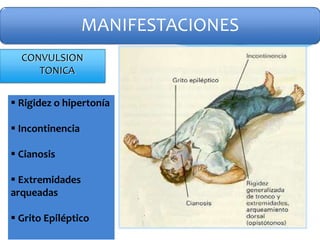 CONVULSION
TONICA
MANIFESTACIONES
 Rigidez o hipertonía
 Incontinencia
 Cianosis
 Extremidades
arqueadas
 Grito Epiléptico
 