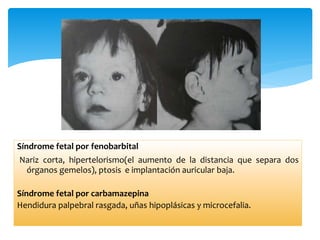 Síndrome fetal por fenobarbital
Nariz corta, hipertelorismo(el aumento de la distancia que separa dos
órganos gemelos), ptosis e implantación auricular baja.
Síndrome fetal por carbamazepina
Hendidura palpebral rasgada, uñas hipoplásicas y microcefalia.
 