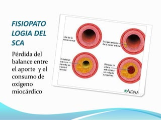 FISIOPATO
LOGIA DEL
SCA
Pérdida del
balance entre
el aporte y el
consumo de
oxígeno
miocárdico
 