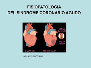 FISIOPATOLOGIA
DEL SINDROME CORONARIO AGUDO
DR LUIS FLORES R1 N
 