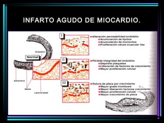 INFARTO AGUDO DE MIOCARDIO.
 
