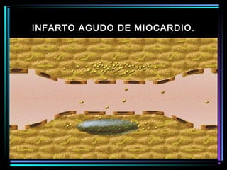 INFARTO AGUDO DE MIOCARDIO.
 