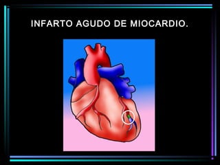 INFARTO AGUDO DE MIOCARDIO.
 
