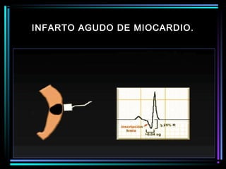 INFARTO AGUDO DE MIOCARDIO.
 