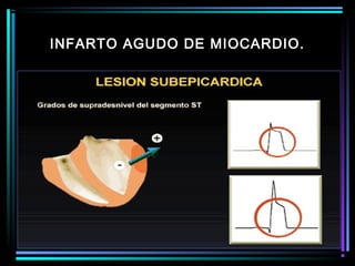 INFARTO AGUDO DE MIOCARDIO.
 