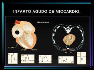 INFARTO AGUDO DE MIOCARDIO.
 
