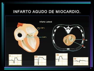 INFARTO AGUDO DE MIOCARDIO.
 