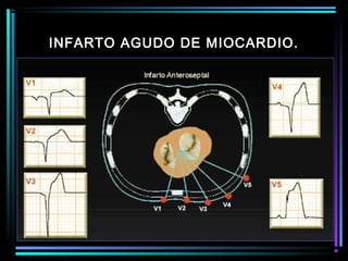 INFARTO AGUDO DE MIOCARDIO.
 
