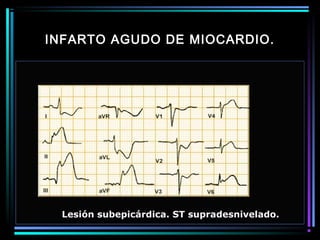 INFARTO AGUDO DE MIOCARDIO.
Lesión subepicárdica. ST supradesnivelado.
 
