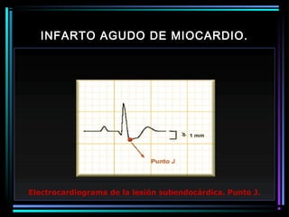 INFARTO AGUDO DE MIOCARDIO.
Electrocardiograma de la lesión subendocárdica. Punto J.
 