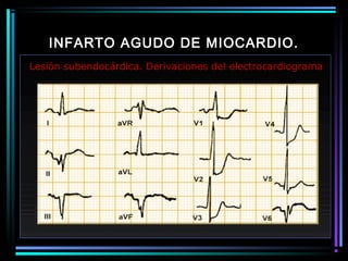 INFARTO AGUDO DE MIOCARDIO.
Lesión subendocárdica. Derivaciones del electrocardiograma
 
