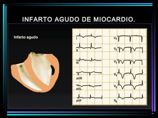 INFARTO AGUDO DE MIOCARDIO.
 