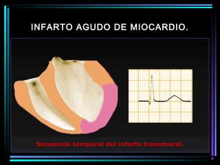 INFARTO AGUDO DE MIOCARDIO.
Secuencia temporal del infarto transmural.
 