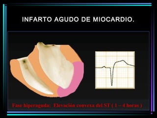 INFARTO AGUDO DE MIOCARDIO.
Fase hiperaguda: Elevación convexa del ST ( 1 – 4 horas )
 