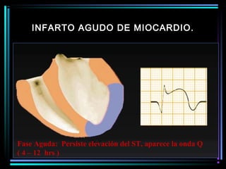INFARTO AGUDO DE MIOCARDIO.
Fase Aguda: Persiste elevación del ST, aparece la onda Q
( 4 – 12 hrs )
 